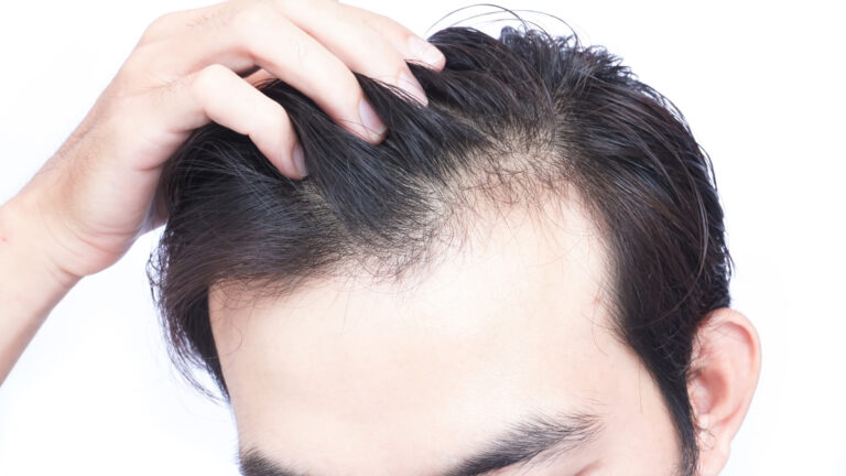 Taking Care Of Hair thinning
